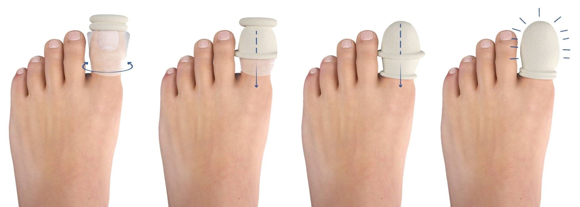 ACELITY ADAPTIC™ DIGIT NON-ADHERING DIGIT DRESSING  photo