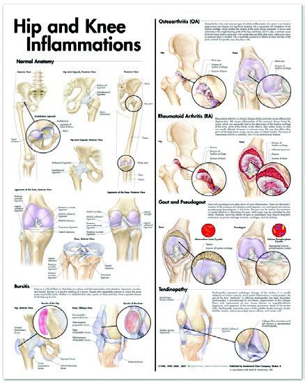 BODYLINE HIP & KNEE INFLAMMATIONS CHART - LAMINATED photo